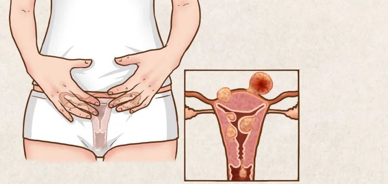 不同的子宫肌瘤都长啥样？看医生如何切除