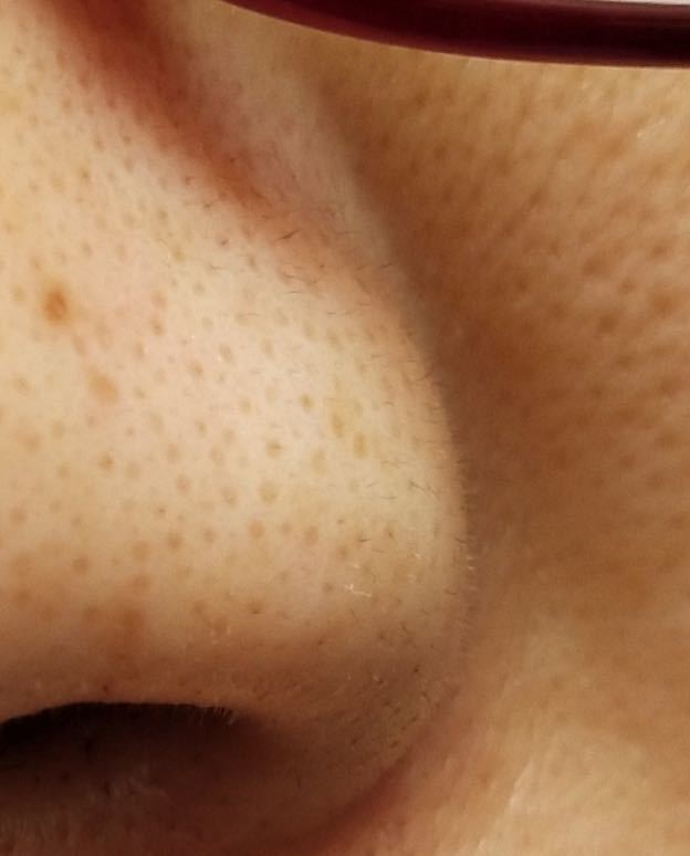 真黑头假黑头傻傻分不清楚，怎么去黑头？