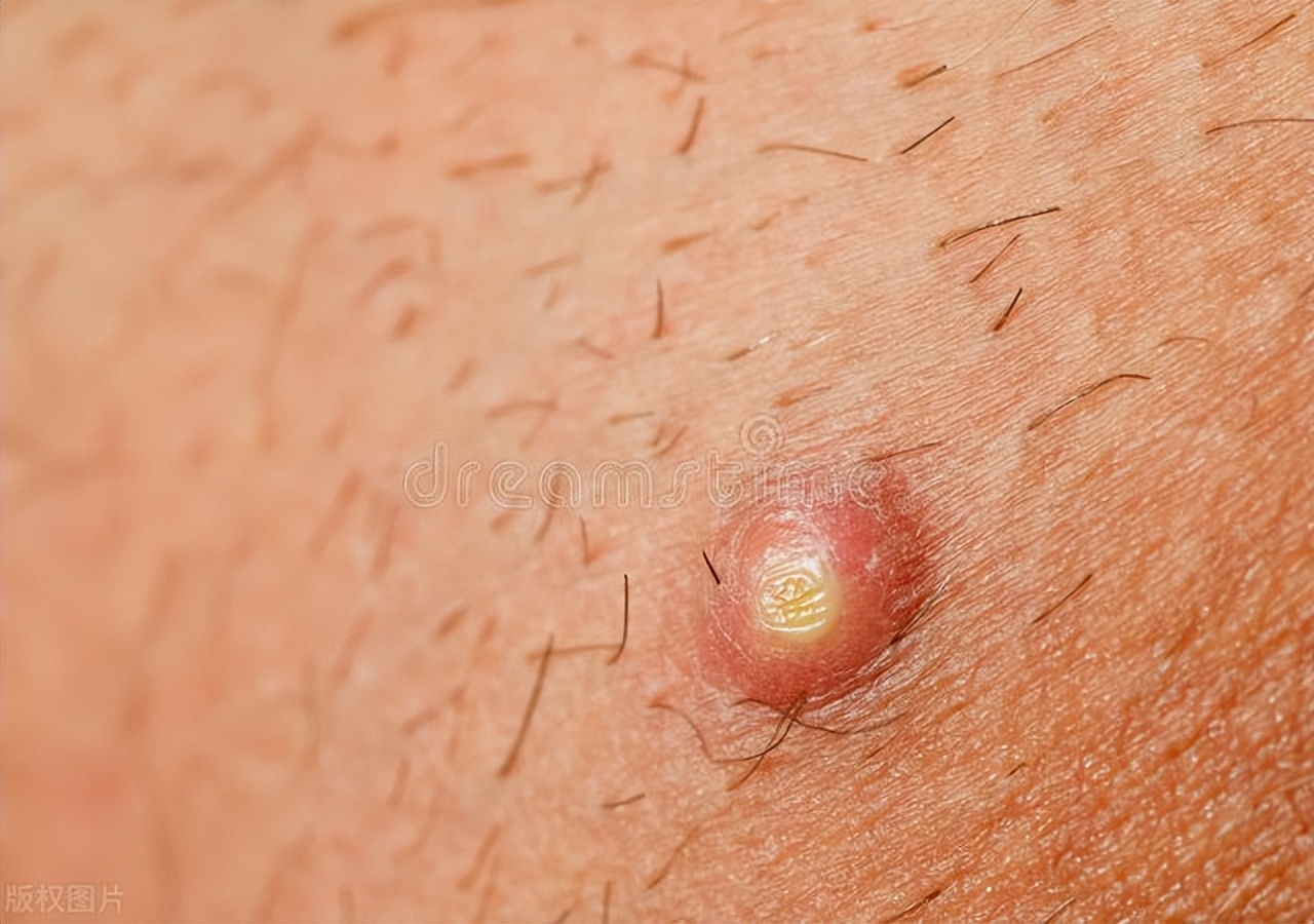 胸口长了个火疖子痒怎么办,火疖子出脓后有点痒是什么原因