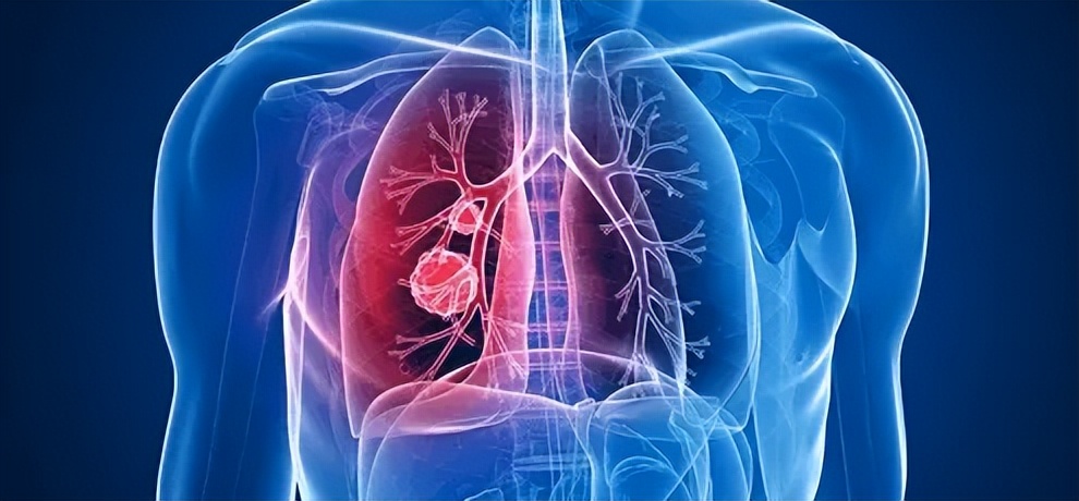 肺癌肾病综合症,32岁女性双下肢水肿