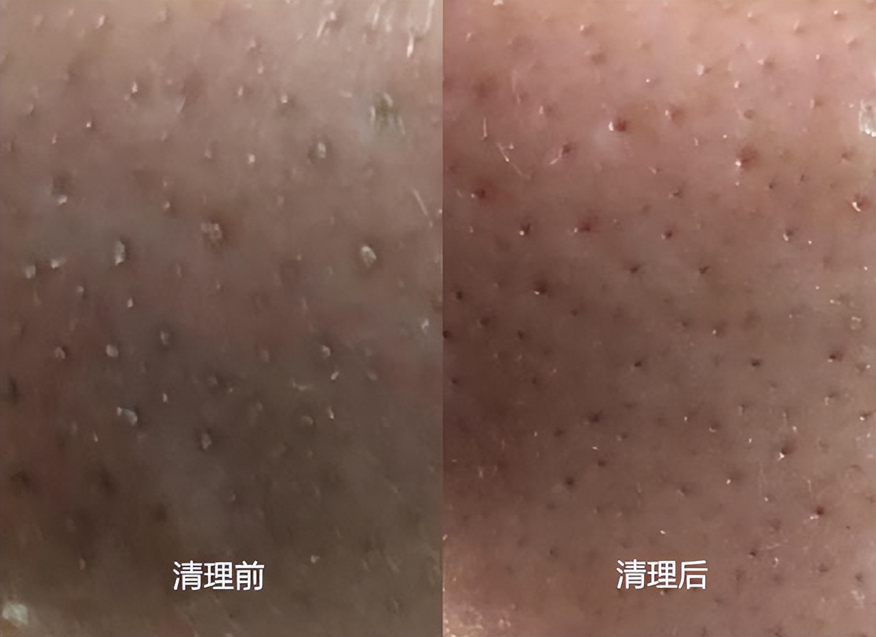 美容院护肤去黑头正常价格,小气泡去黑头美容仪器