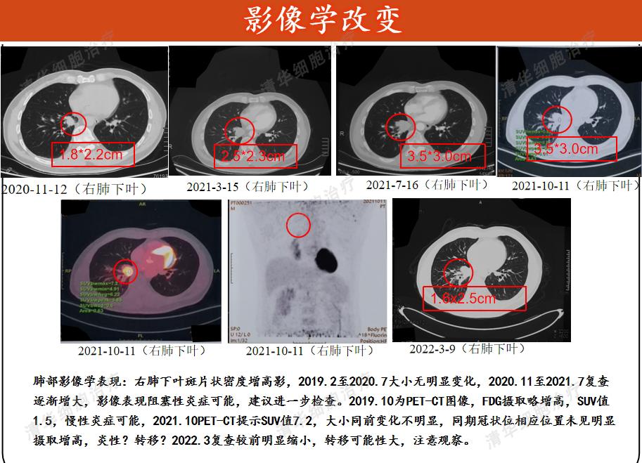 患癌20年经历2次转移最终抗癌成功,肾癌10年后发生转移