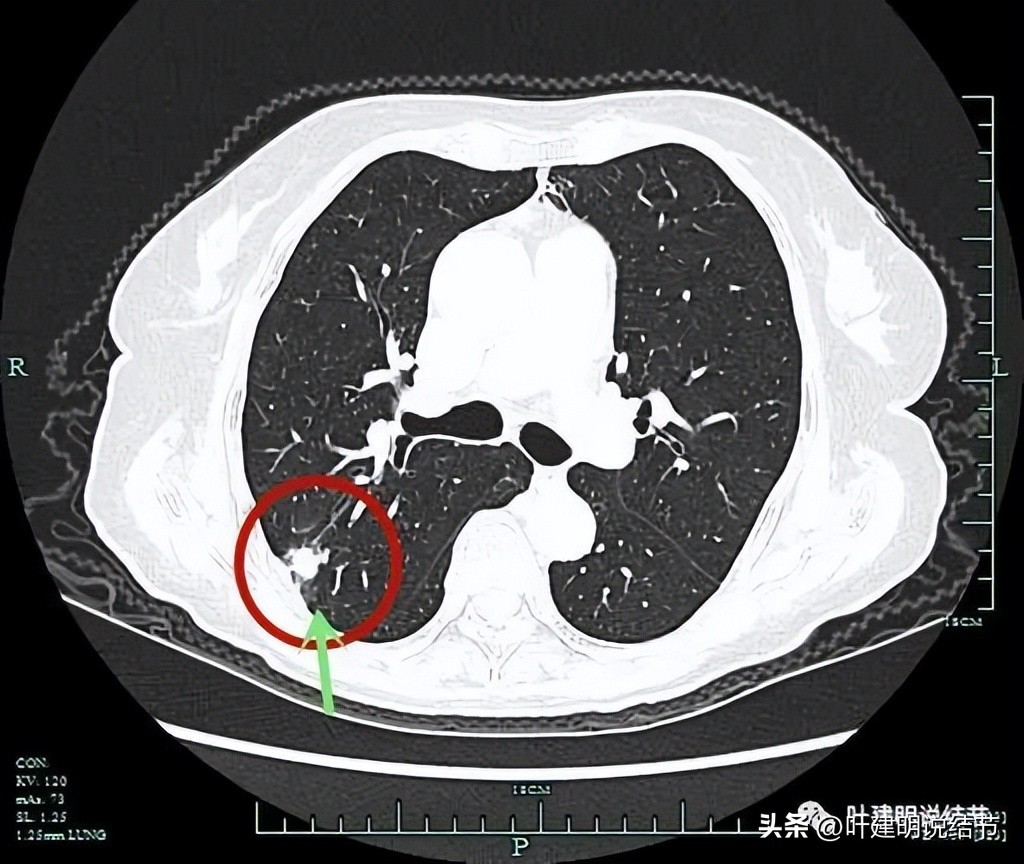 79岁肺癌早期手术风险,75岁早期浸润性肺癌还要治疗吗