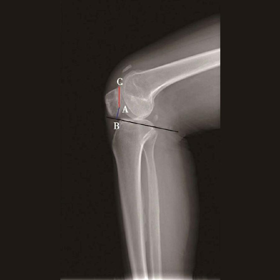 髌骨骨折评估,髌骨上下滑动评估什么内容