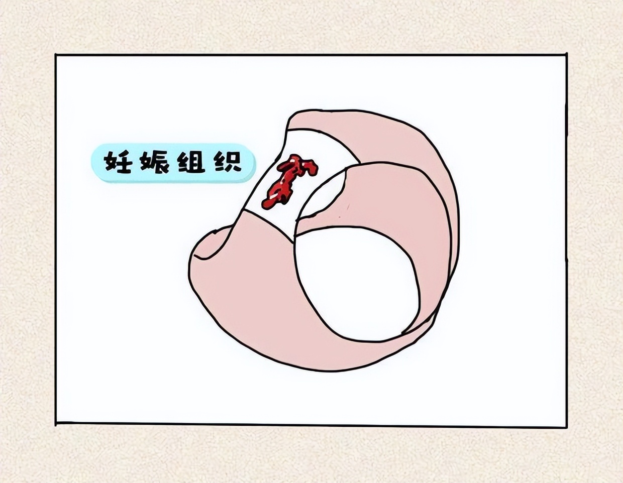 姨妈巾上不仅有经血，还出现了一坨“肉”，这究竟是什么东西？