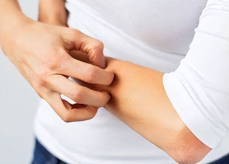 银屑病痒吃什么药止痒,银屑病特别痒怎么止痒