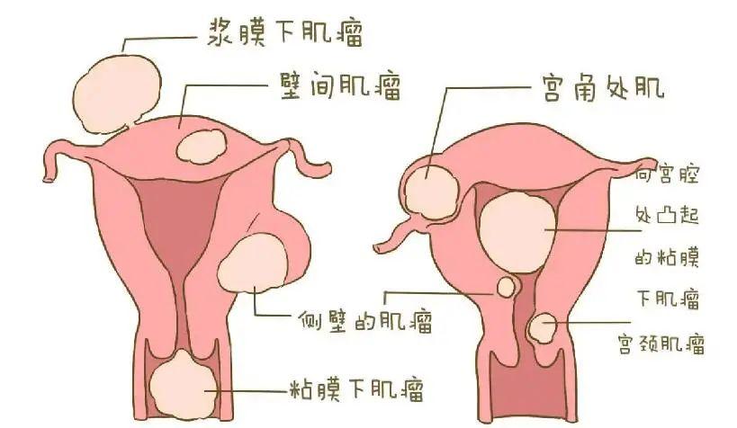 妇科肌瘤介入科,妇科介入治疗是什么