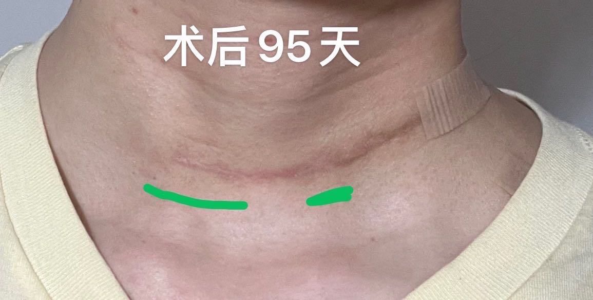 甲状腺癌手术全切疤痕多久能消除,甲状腺癌全切手术后的真实感受