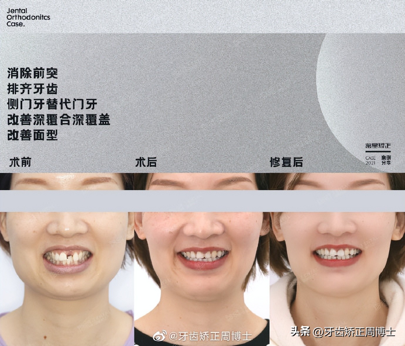骨性前突正畸后多长时间有效果,牙性下巴后缩可以戴牙套改善吗