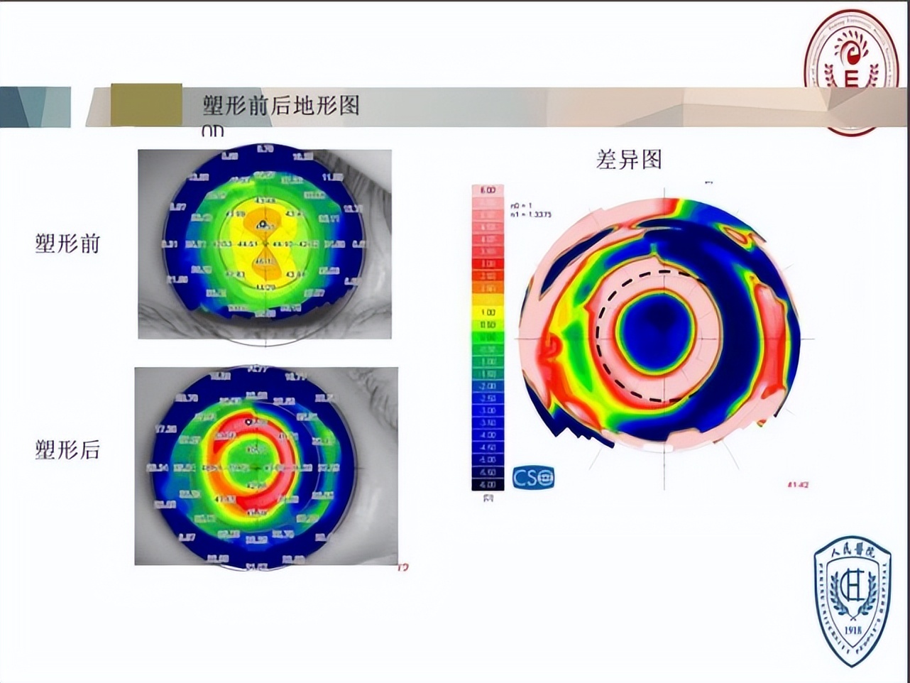 王凯角膜塑形镜原理,王凯医生塑形镜