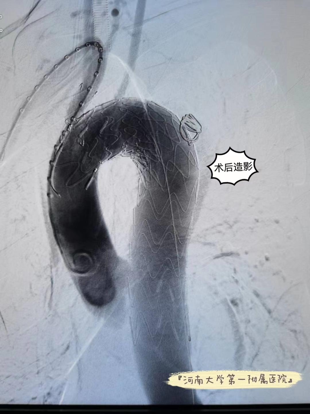 主动脉夹层救活的几率大不大,主动脉夹层腔内重建修复术