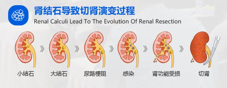 肾结石是不是经常发作,肾结石有石头不痛要治吗