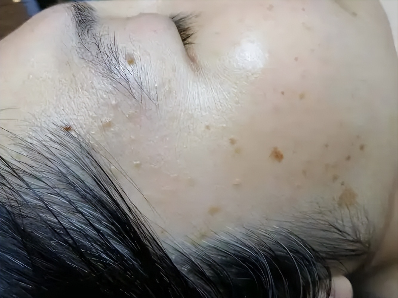 脖子和腋下的小肉粒是什么,脖子和腋下长小肉刺会自己脱落吗