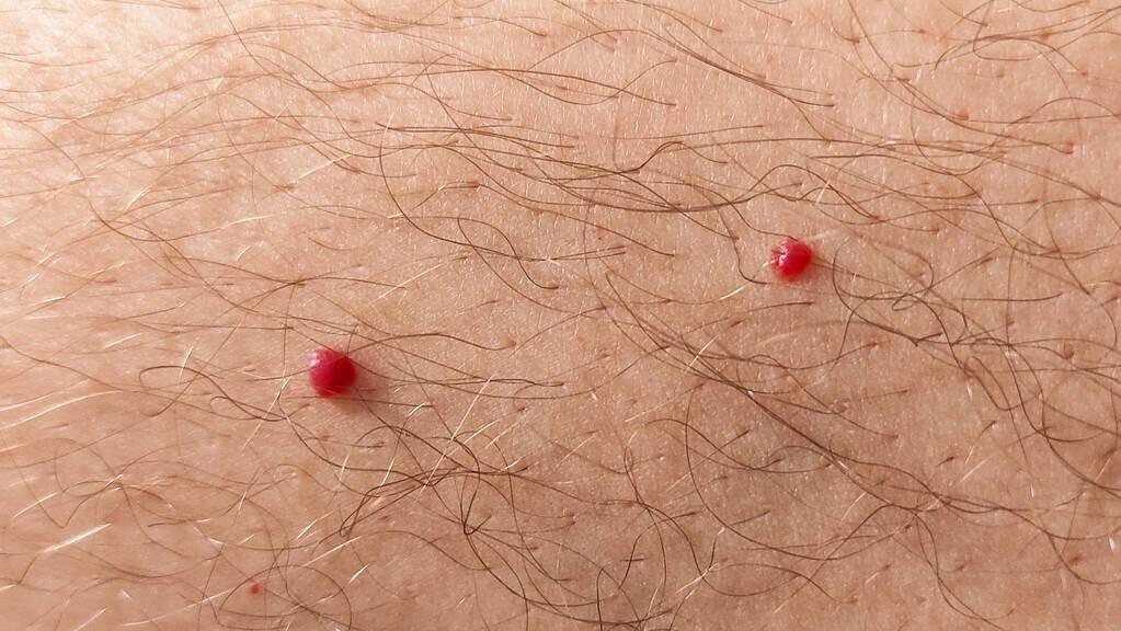 血管瘤要怎么治疗效果才最好,发现血管瘤怎么治疗好