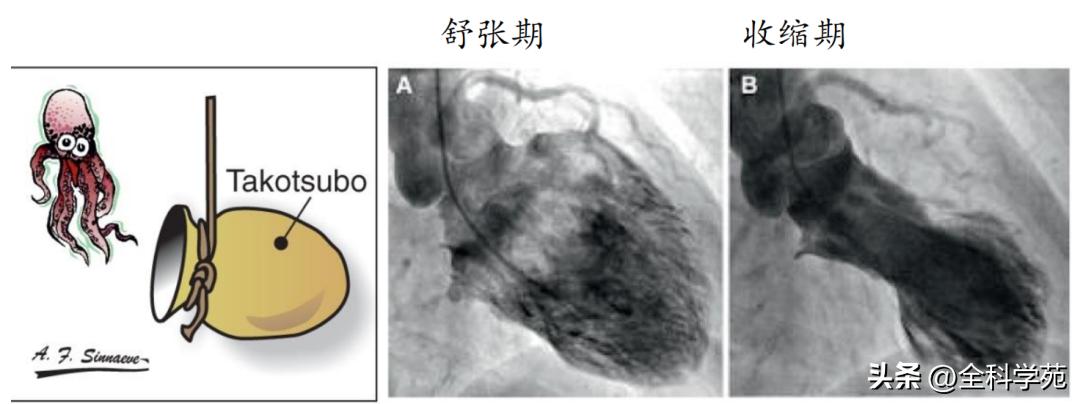 t波倒置三种常见原因,t波低平倒置有事吗