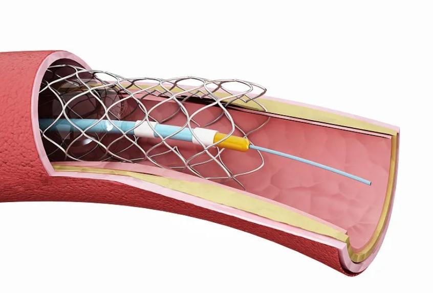 做完冠脉造影，病人就活不久了？冠脉造影检查对人体有什么危害？