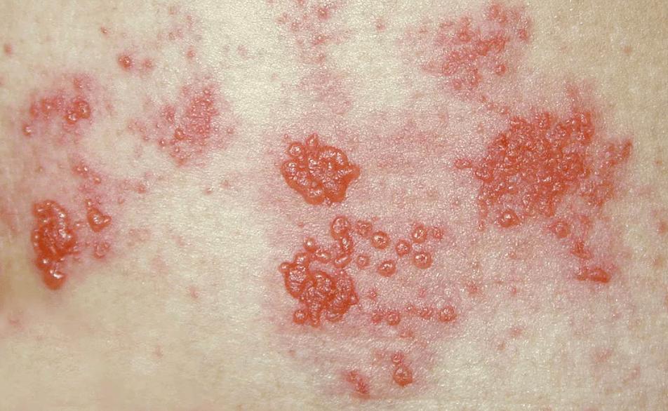 得了带状疱疹痒的睡不着,带状疱疹疼痛难忍三步简单解决