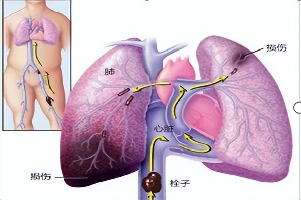 腿部青紫且疼怎么回事,腿上出现青紫筋咋回事