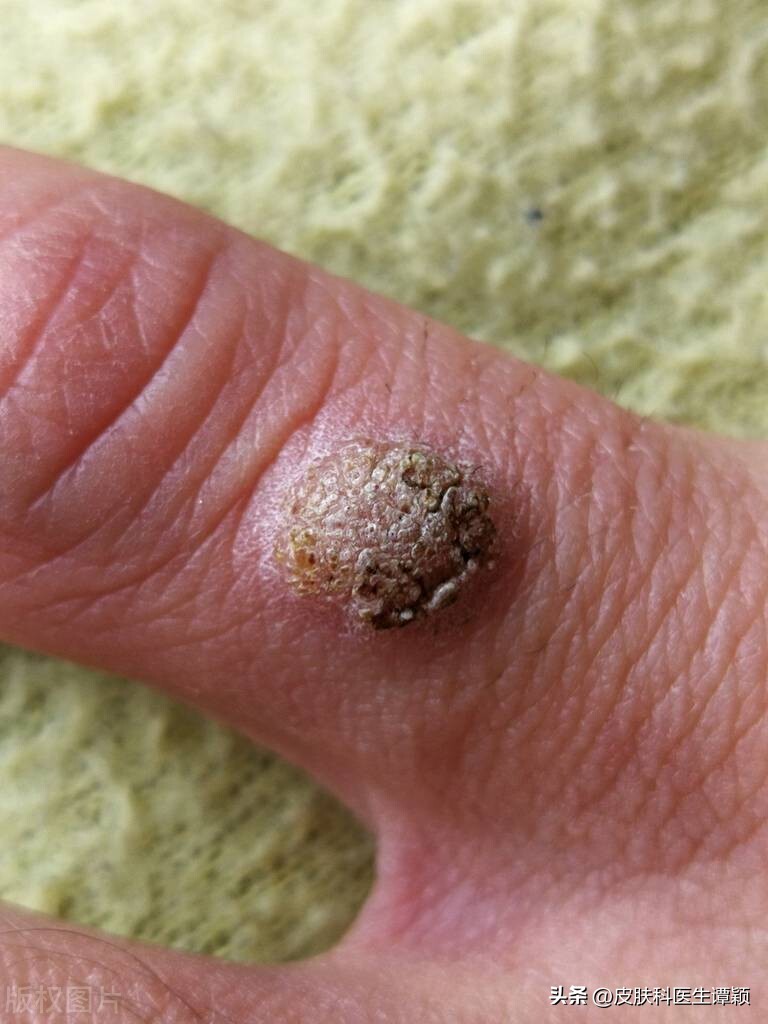 皮肤科医生讲疣,皮肤科病毒疣