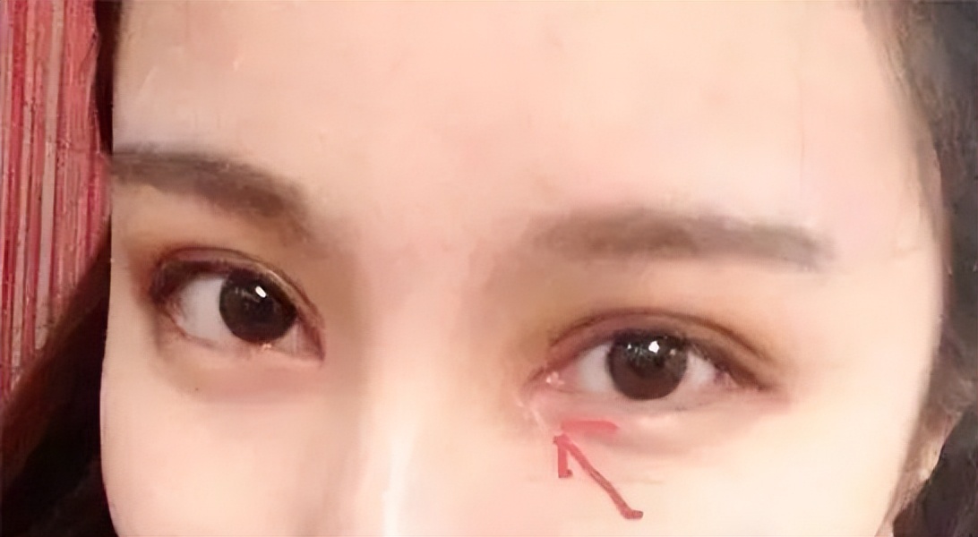 太原丽都双眼皮做的怎么样,太原市丽都整形医院做的好吗