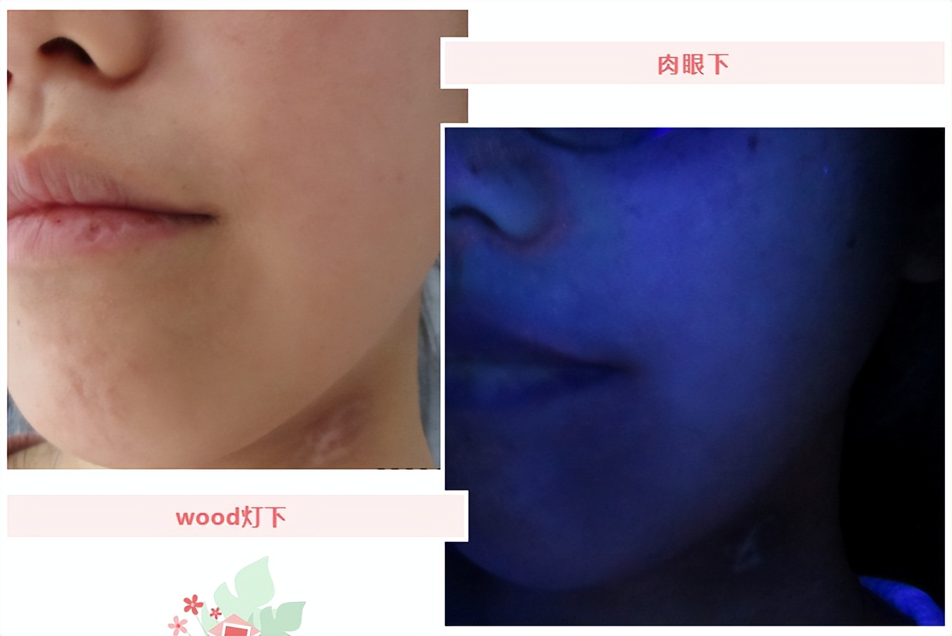 成年人脸部白斑怎么治疗最有效,儿童面部白斑消除最简单方法