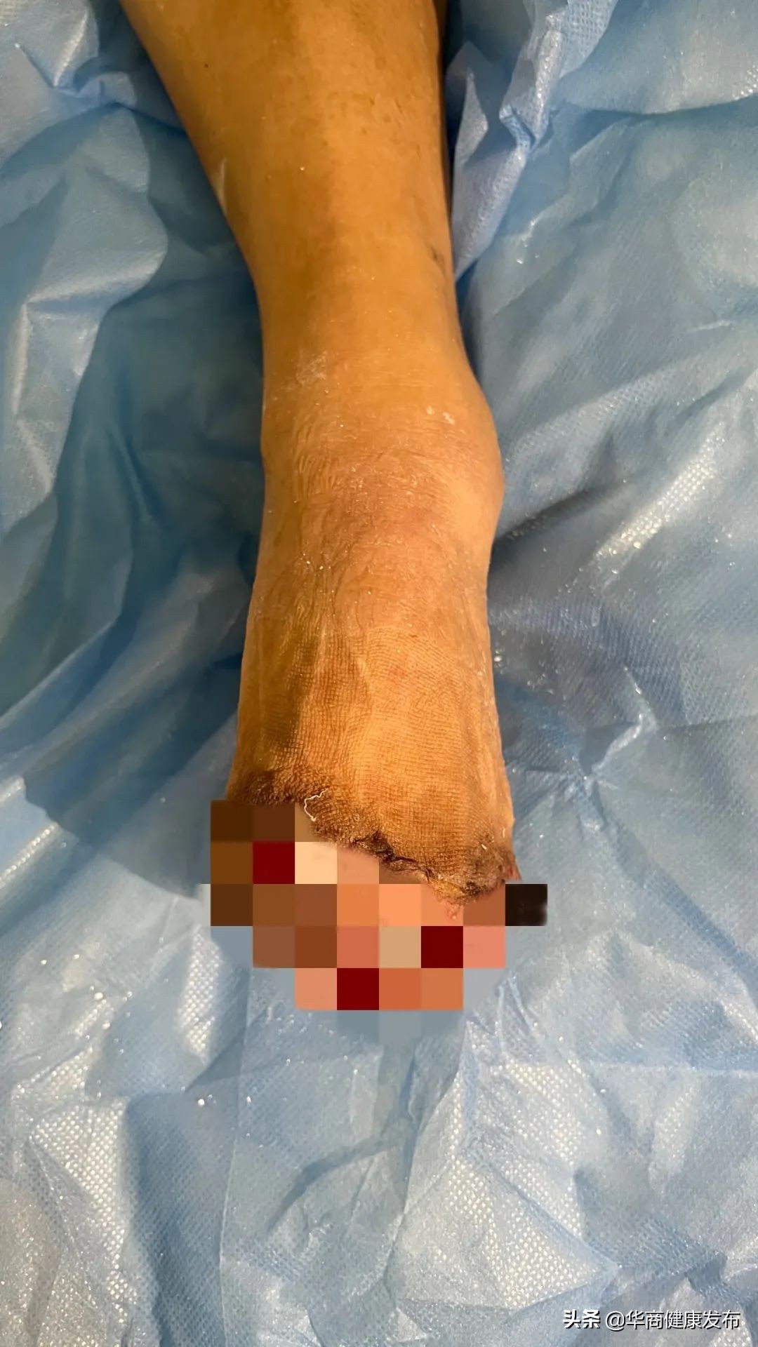 -30°低温冻伤双脚三次手术为其保留“残足长度”