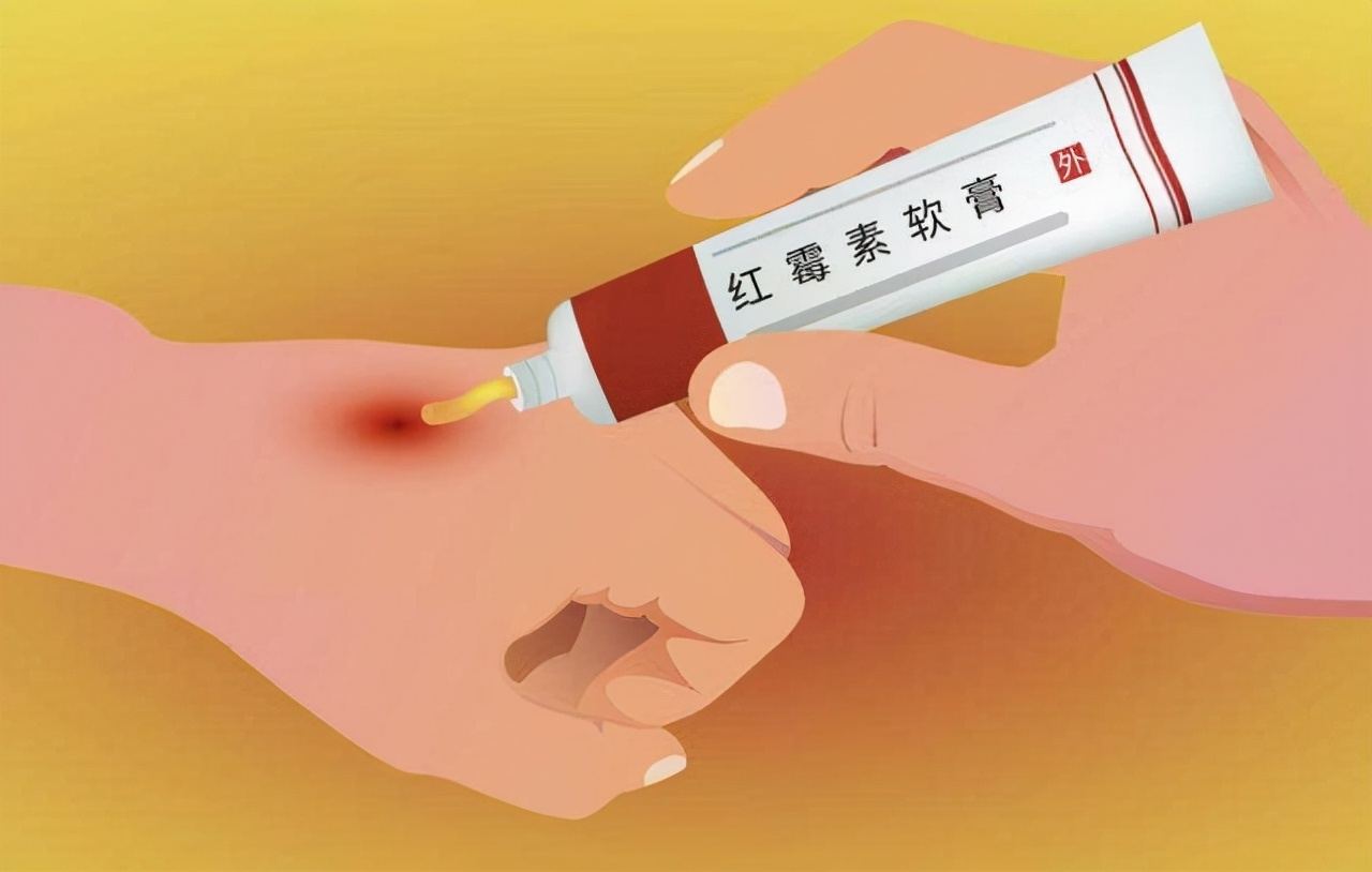 人为什么会长老人斑？红霉素软膏可以去除老人斑？本文告诉你真相