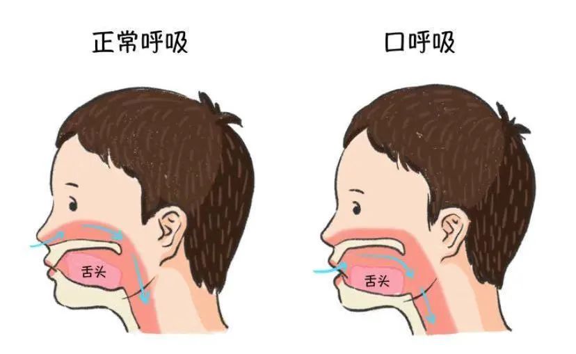 口呼吸|听说变丑是因为习惯用嘴呼吸？