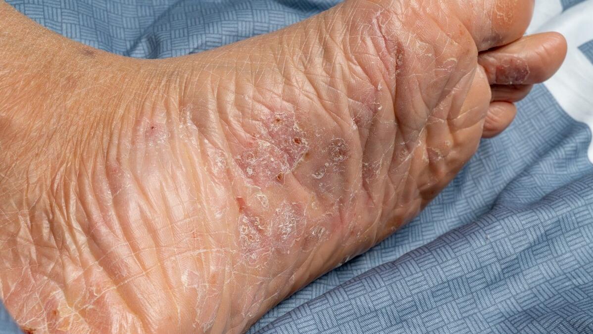 脚气用喷雾还是药膏好得快,脚气很痒可以频繁涂药膏吗