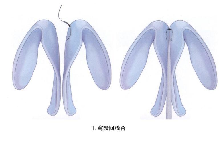 隆鼻以后鼻孔外露算是失败吗,露鼻孔的鼻子怎么隆鼻