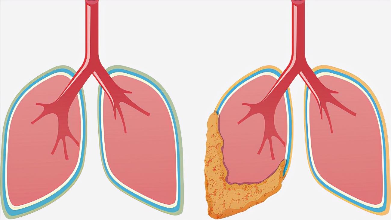咽喉炎肺会有症状吗,如果咽喉肿痛怎么办