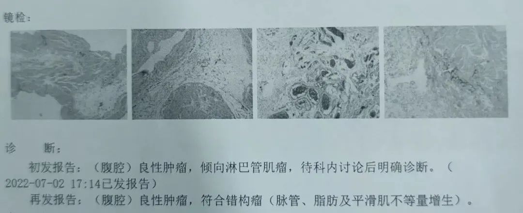 花季少女切除脏器,花季少女肚子肿瘤