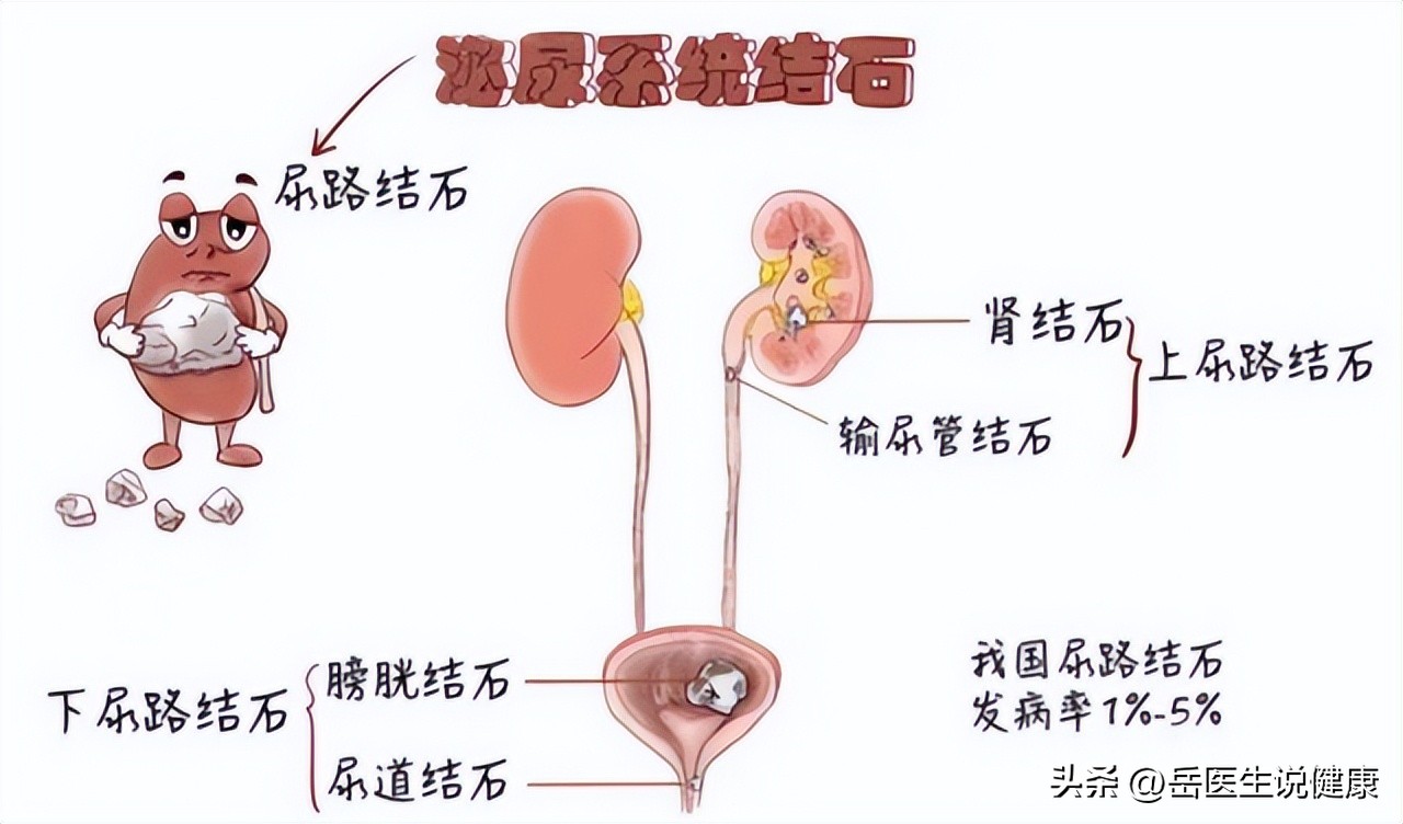 尿路感染用哪种抗生素好得快,尿路感染严重时是不是常用抗生素