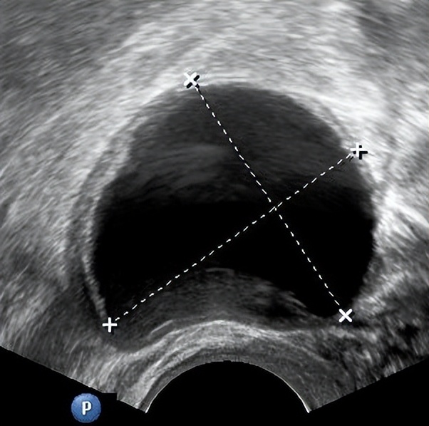 卵巢囊肿超声穿刺手术怎么做的,黄体囊肿与卵巢囊肿的超声区别