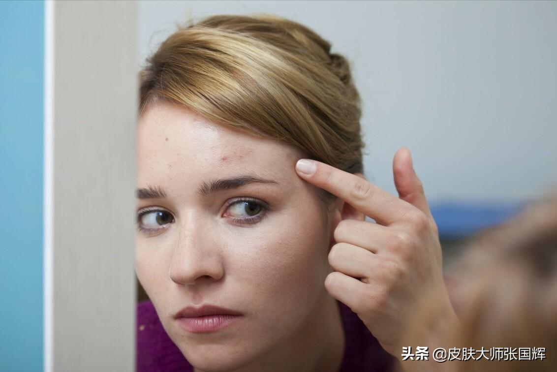 年轻人有痘痘要吃什么好,有痘痘吃什么更容易让它消失