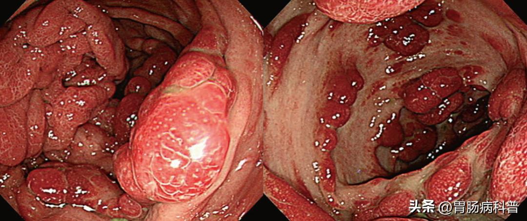 肠息肉四种表现,肠息肉什么样的容易癌变