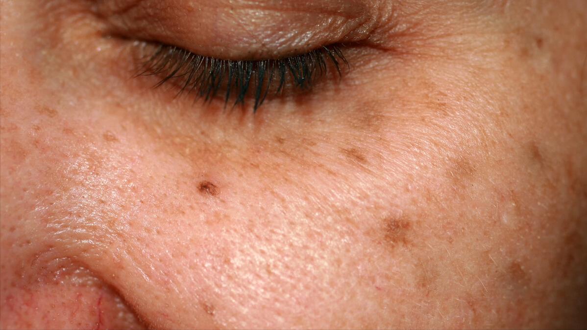 红霉素软膏可以治疗手上老年斑,红霉素软膏可以去除老年斑么