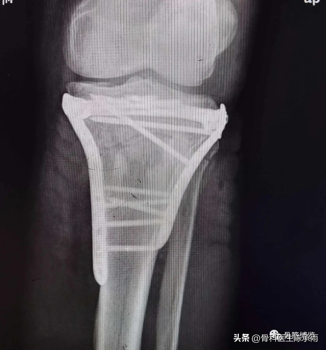 膝关节胫骨平台骨折,最近胫骨平台骨折视频