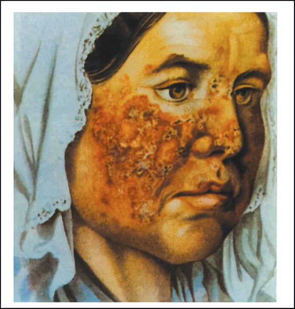 狼疮病叫什么病,狼疮得了十年