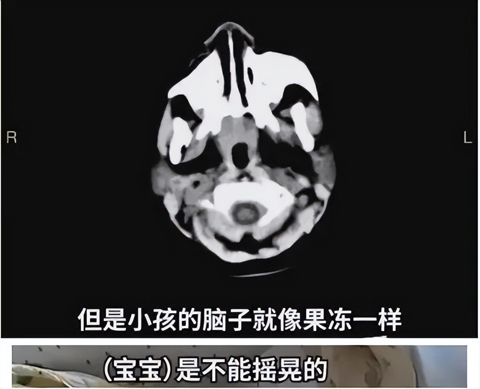 奶爸哄娃失手把孩子摔成重度脑伤,哄娃失手摔成脑损伤后续怎么样了