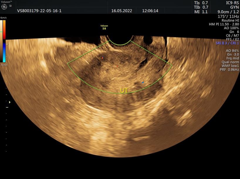 胎盘植入是清宫还是超声聚焦,胎盘植入保胎成功案例