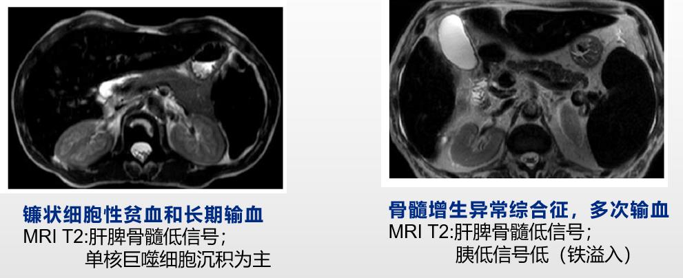 郑素军谈乙肝难点,肝病专家郑素军