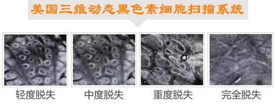 发展期的白癜风一般多长时间治愈,发展期的白癜风怎么治疗