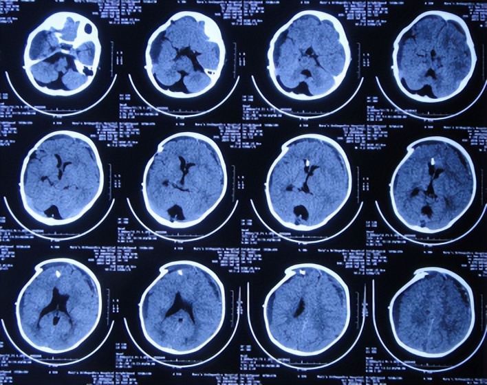 蛛网膜囊肿合并脑积水腹腔分流术,治疗蛛网膜囊肿引起脑积水严重吗