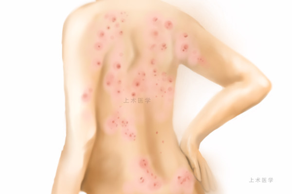 孕妇感染梅毒后传染给婴儿吗,孕妇感染梅毒会传染给胎儿吗