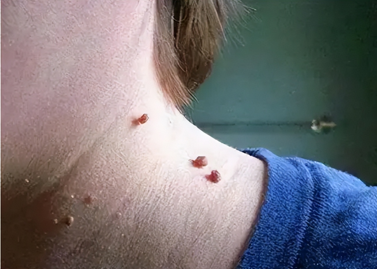 脖子上长的小肉粒可以揪掉吗,脖子和腋下的小肉粒可以揪掉吗