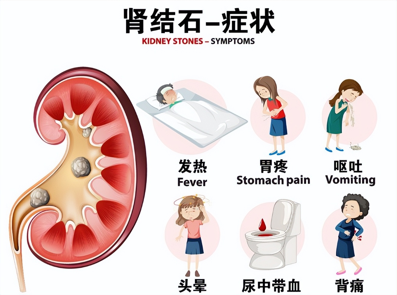 出现肾结石问题一定要明白这几点,关于肾结石你了解多少
