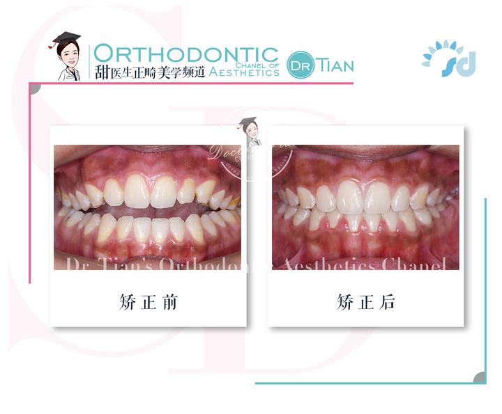 上下牙无法咬合是怎么回事,30岁牙齿咬合开颌还有必要矫正吗