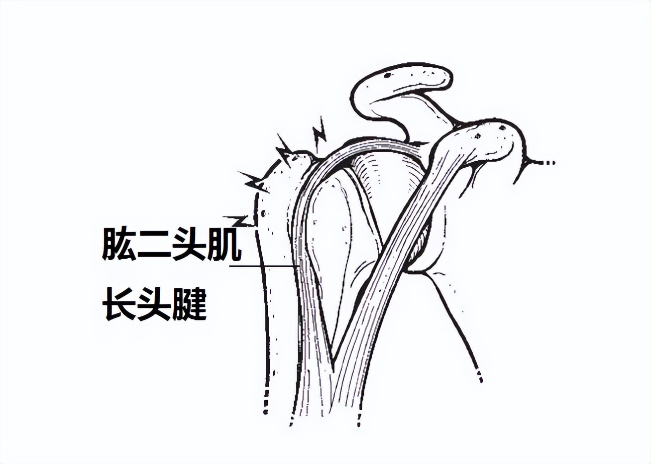 肩周炎如何缓解肩膀疼痛,肩周炎肩膀疼有什么原因