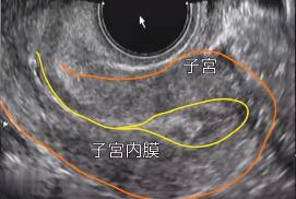 试管胚胎移植需要憋尿吗,试管婴儿胚胎移植需要憋尿多久
